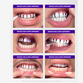SmileGlow- Pack Dentrifrce Blanchissant probiotique(Élimine des années de taches)