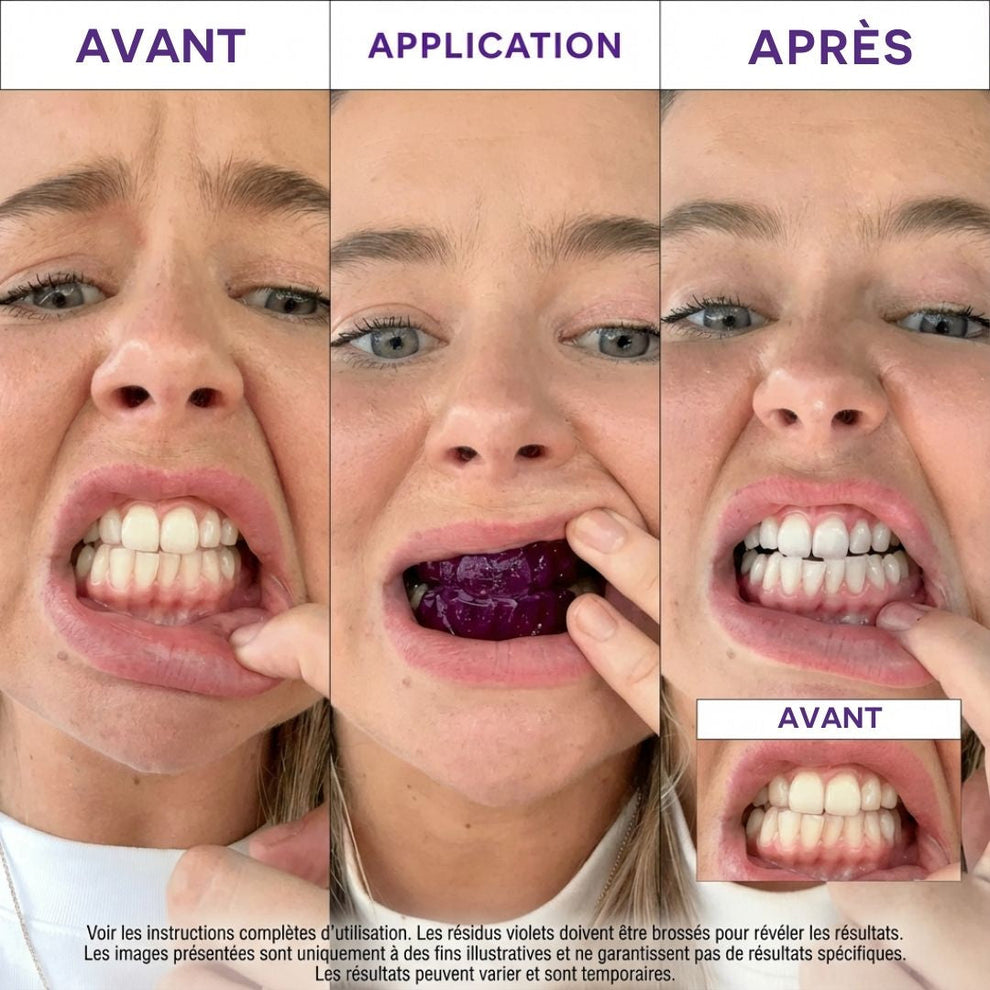 SmileGlow- Pack Dentrifrce Blanchissant probiotique(Élimine des années de taches)