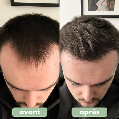 Rehaire – Sérum Roll-On Anti-Calvitie • Repousse en 90 jours